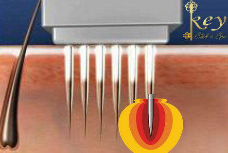 công nghệ trị sẹo, trị mụn